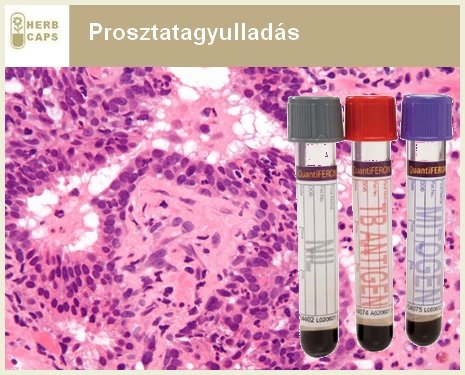 prosztatagyulladás, prostatitis, prosztatitisz prosztatagyulladás, prostatitis, prosztatitisz